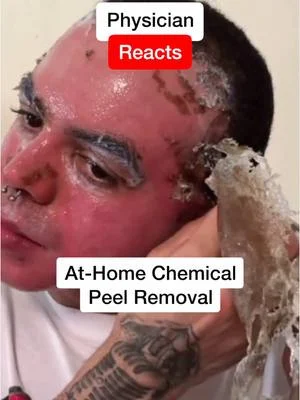 Thinking of removing your chemical peel at home? Think again!
