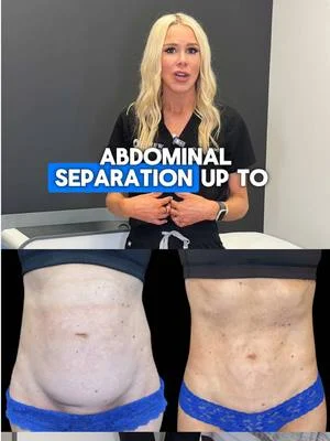 Pre-pregnancy body without surgery? It’s possible with Emsculpt Neo!
