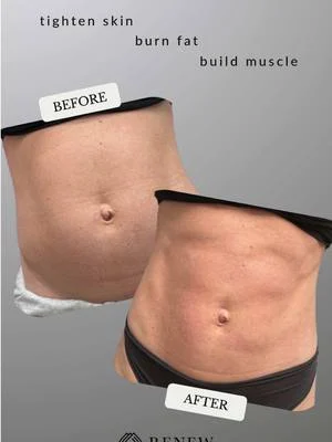 Tighten skin, burn fat and build muscle with zero effort! 💪🏼 #renewoklahoma #emsculptneo 