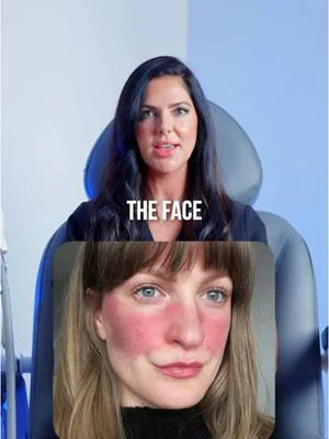 Here’s how we can treat your rosacea! ✨ Credits: @beautyxrenate #renewoklahoma #aesthetics...