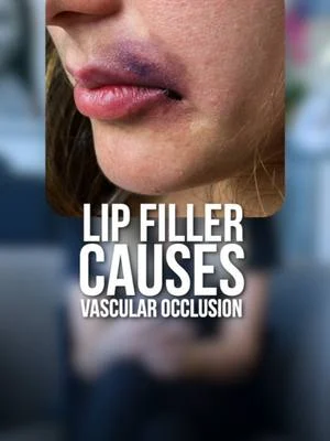 Always consult a qualified injector to minimize the risk of complications!