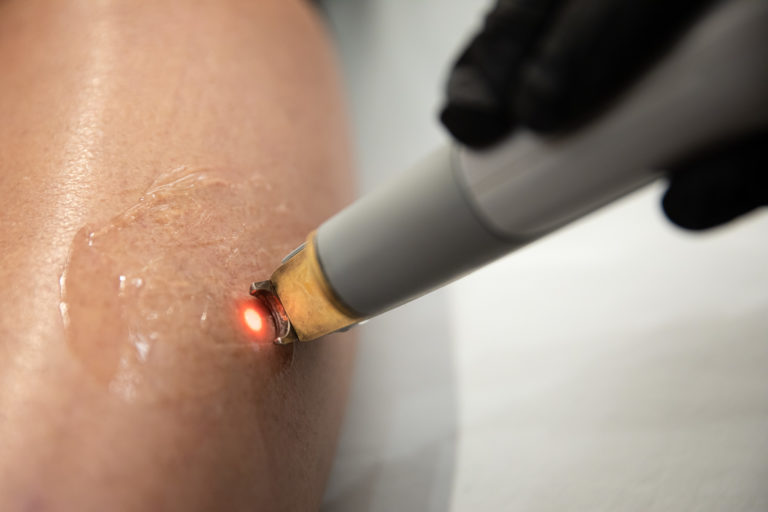 laser vein treatment on arm