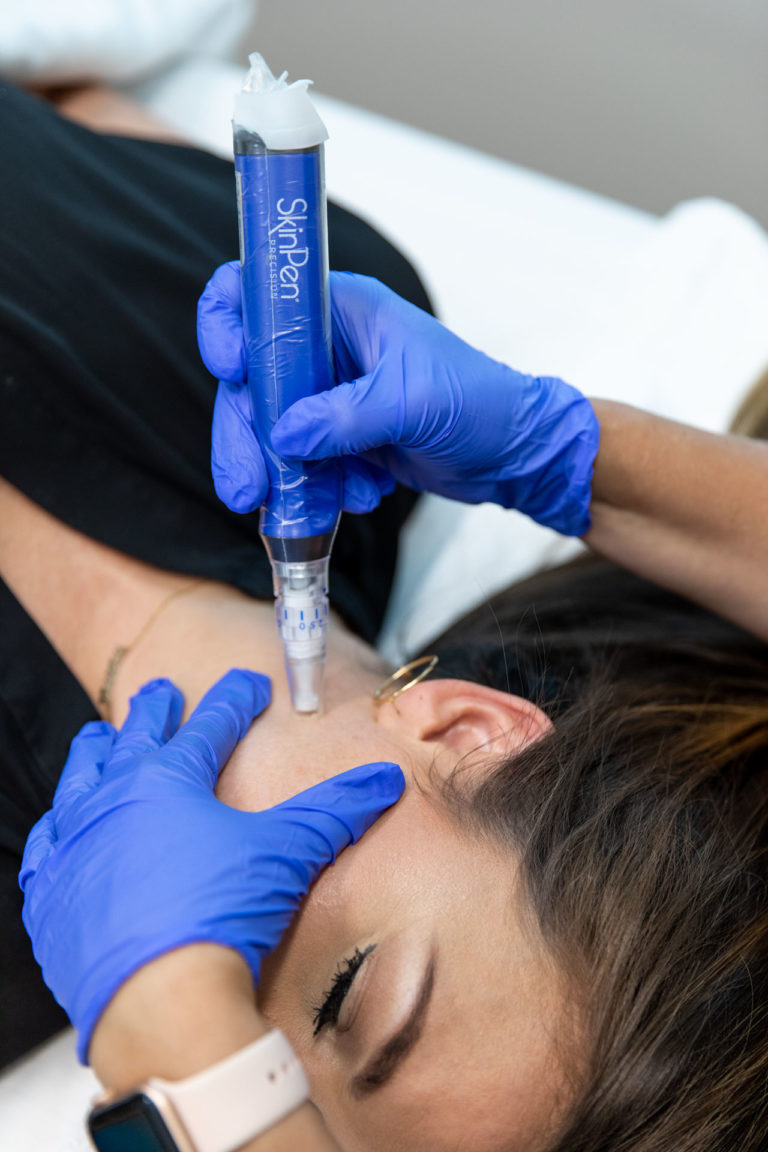 skinpen in use on woman