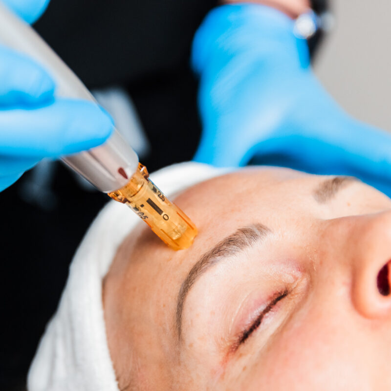 Photo of microneedling near Edmond on a woman's forehead