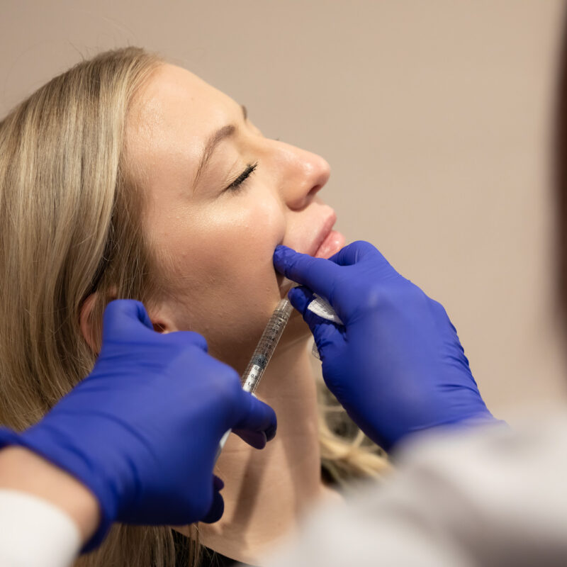 Lip filler treatment at Renew in OKC