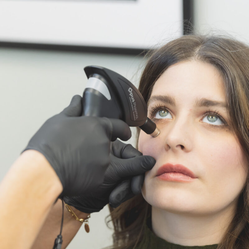 photo of woman receiving opus plasma for sun damage treatment OKC