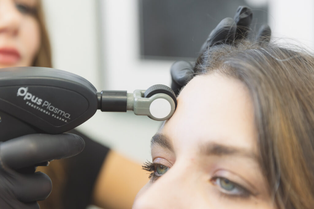 A woman is given a microneedling treatment