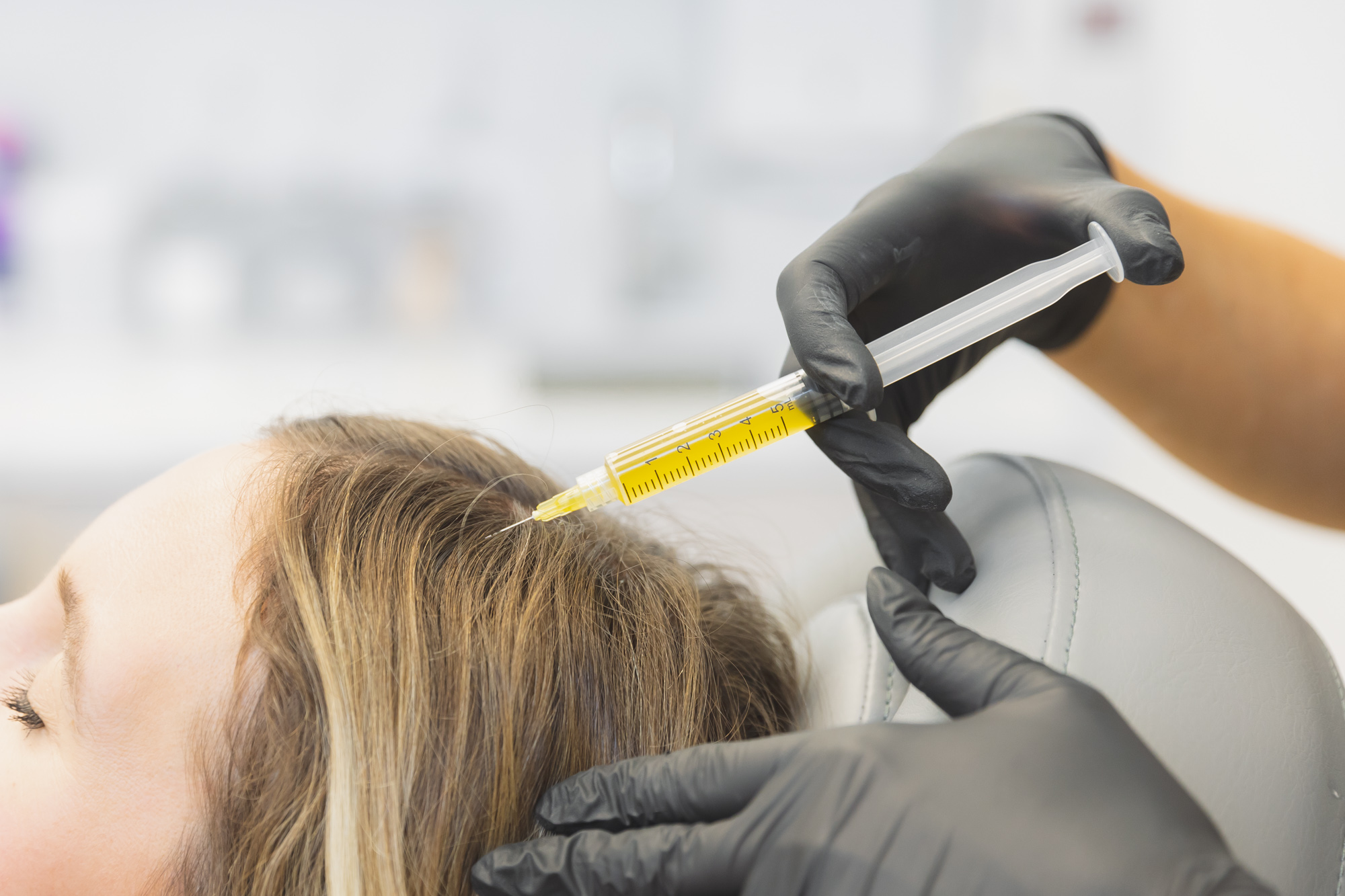 photo of woman receiving prp hair restoration
