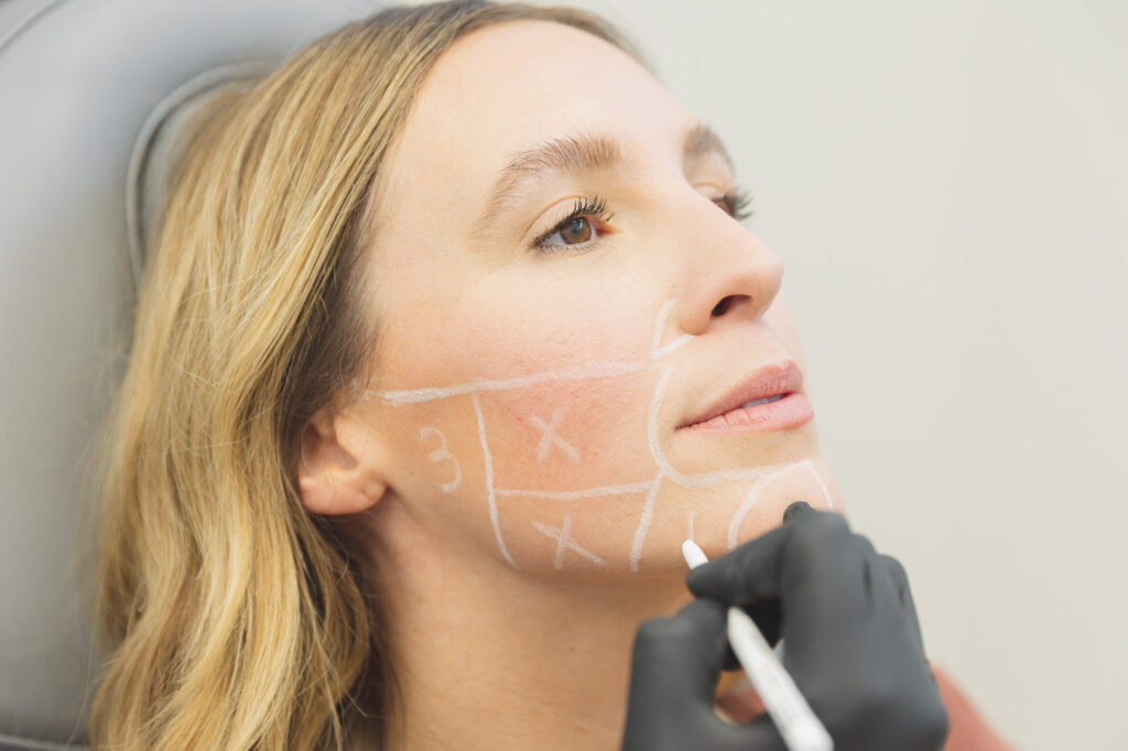 woman getting sketched on for scupltra injections in Oklahoma City