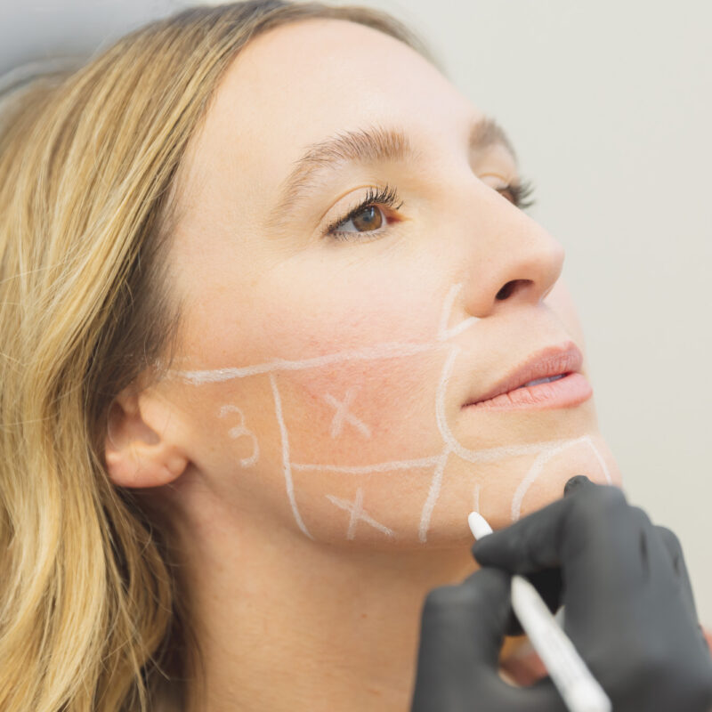 woman getting sketched on for scupltra injections in Oklahoma City