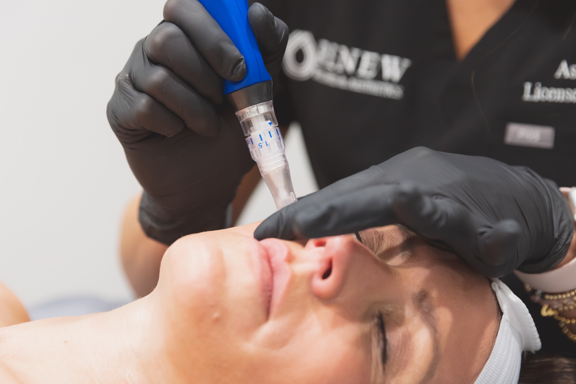skinpen microneedling tool in use on womans face