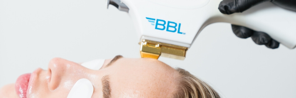 BBL Hero laser treatment at Renew Wellness & Aesthetics in Oklahoma City